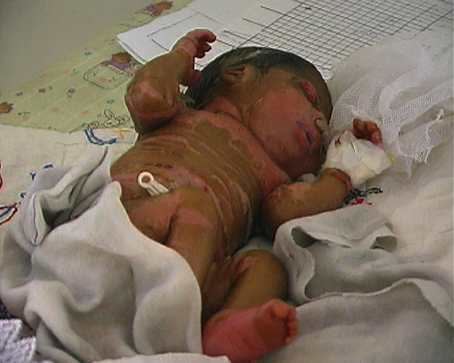 erkrankter Säugling im Irak